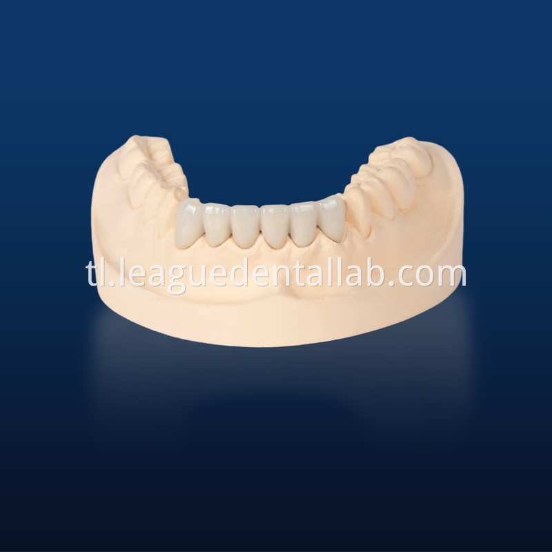 PFM,Metal crown,Fixed metal crown